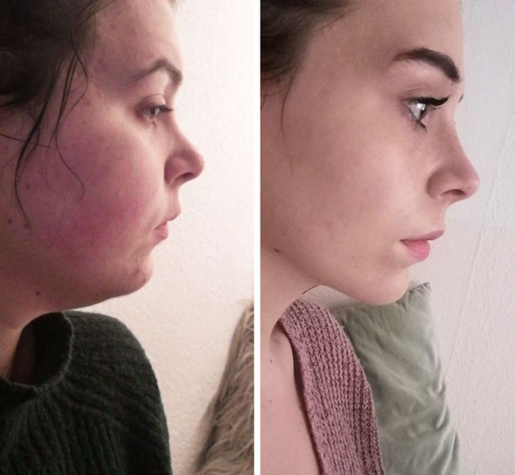 Antes e depois — contorno mandibular mais definido